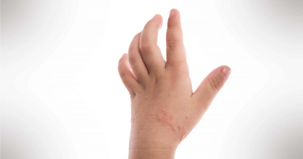 Pengeluar Minyak VCO Perak baik untuk eczema
